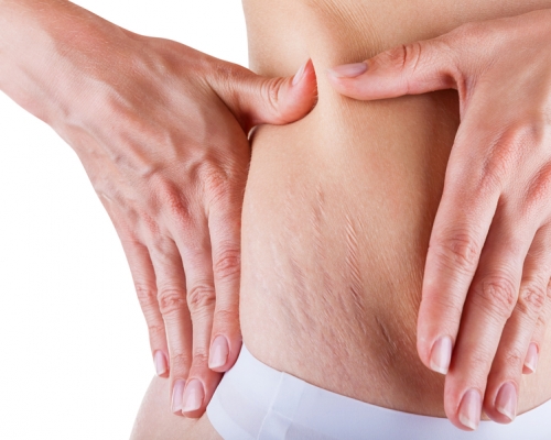 Stretch Marks Removal
