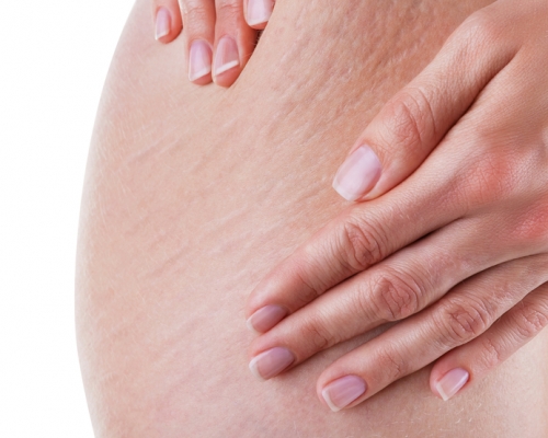 Stretch Marks Removal