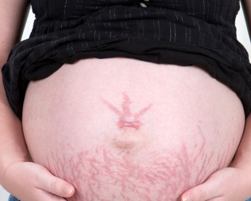 Stretch Marks Removal