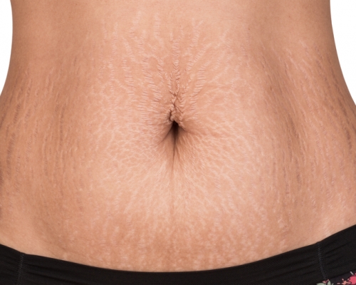 Stretch Marks Removal