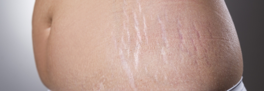 Who Gets Stretch Marks?