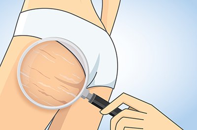 Stretch Marks