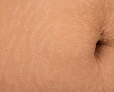 Stretch Marks FAQ